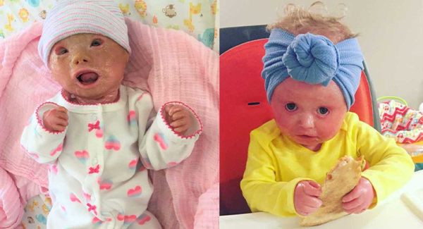 A baby girl who 'never stops smiling' is living with a rare condition that makes her skin crack